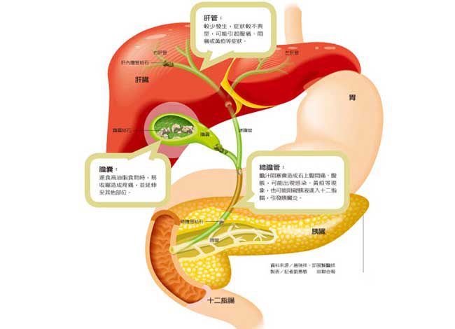 胆结石有哪些表现症状